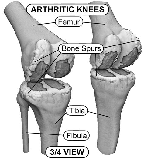 Bilateral Knees With Arthritis Hip And Knee Handbook Of Joint Replacement