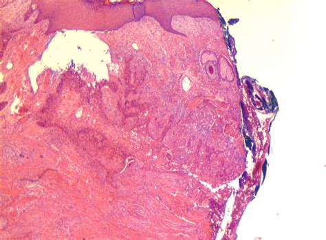 Histology Of An Undifferentiated Squamous Cell Carcinoma Of The Patient