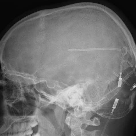 Lateral Skull Radiograph Performed In Our Patient At Age 4 Years Shows