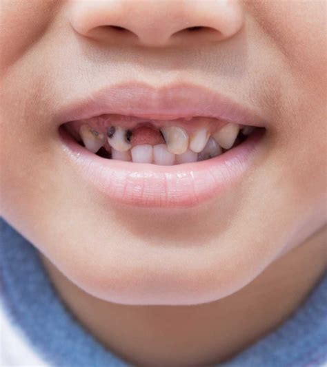 Tooth Decay Rotten Teeth In Children Causes And Treatment