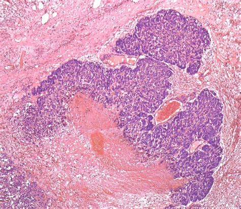 Salivary Gland Cancer Lm Stock Image C0506864 Science Photo Library