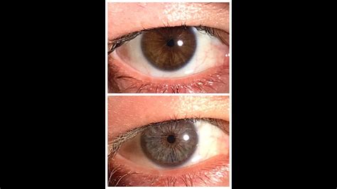 He Permanently Change His Eye Color With A Laser Procedure Irex Laser