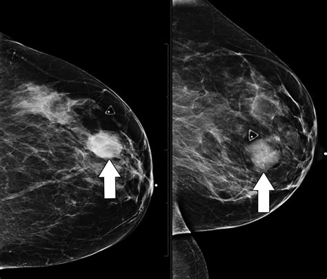 Phyllodes Tumor Of The Breast Ultrasound Pathology Correlation Ajr