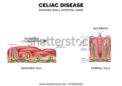 Celiac Disease Affected Small Intestine Healthy Stock Illustration