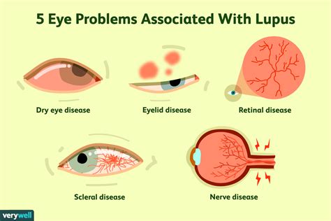 5 Formas En Que El Lupus Afecta Los Ojos Medicina Básica