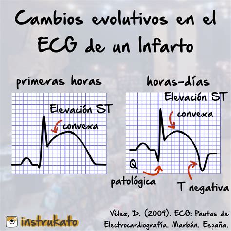 Evolucion Del Iam En El Electrocardiograma Ekg Electrocardiograma The Best Porn Website