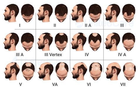 6 Painfully Accurate Signs Of Balding How Do I Tell If Im Going Bald