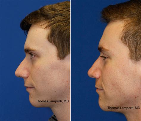 Droopy Tip Rhinoplasty In Seattle