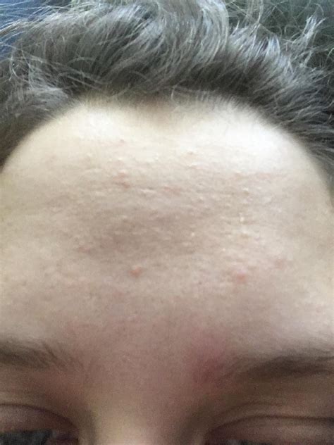 Ive Had A Few Bumps On Forehead For A While But This Week So Many More