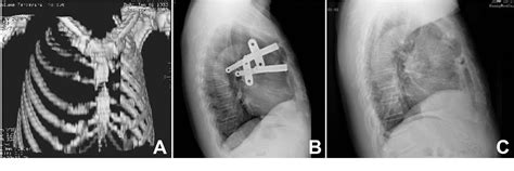 Figure From Thoracoscopy Assisted Minimally Invasive Surgical