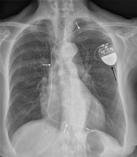 Frontal Chest Radiograph Showing A Single Lead Pacemaker Device With