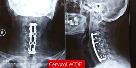 Cervical Spine Surgeries