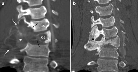 Aneurysmal Bone Cyst Abc Of The Cervical Spine Involving Two