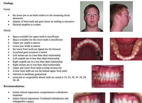 Overbite Jaw Surgery Log March 14th Forums