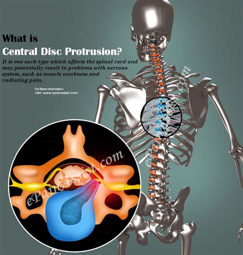 Central Disc Protrusioncausessymptomstreatment