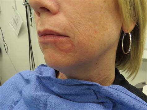 Lip Biopsy For Sjogren S Syndrome Minor Salivary Gland Biopsy Using Chalazion Clamp Iowa