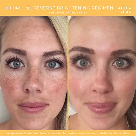 20 Rodan And Fields Before And After Pictures That Will Shock You The