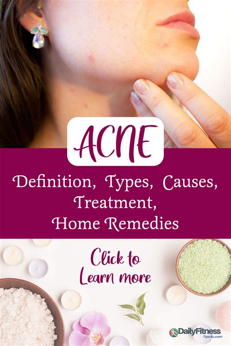 Acne Definition Causes Home Remedies And Prevention In 2020 Acne