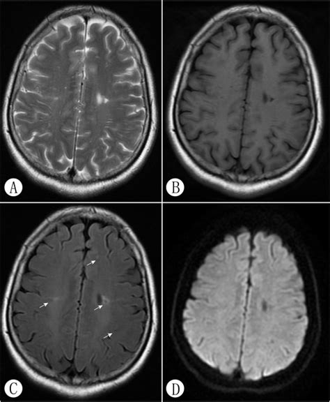 Clinical Laboratory And Brain Magnetic Resonance Imaging Mri