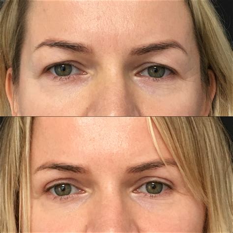 Upper Blepharoplasty Before And After Photos Flora Levin Md