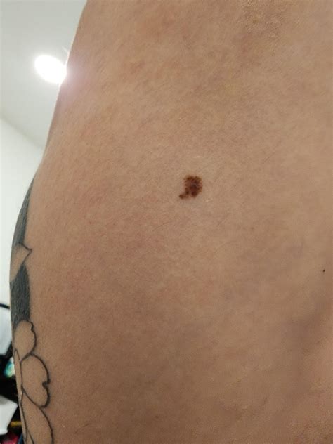 Raised Lump On Scar After Mole Removal By Incision 1 Year Later R