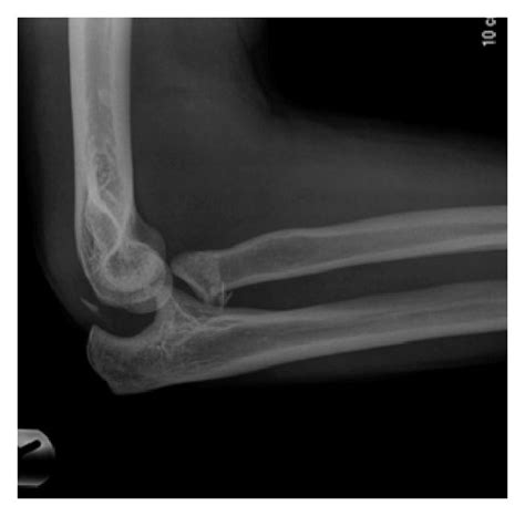 Fracture Dislocation Of The Elbow With Avulsed Fragment Of Olecranon