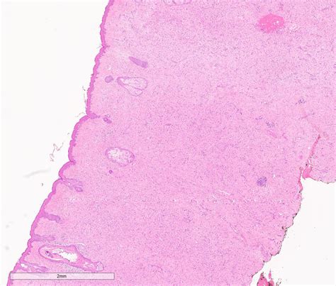 Solitary Neurofibroma Of The Face Masquerading As A Low Flow Vascular