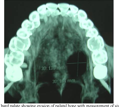 Pdf Pleomorphic Adenoma Of Palate A Case Report With Ct And Cbct