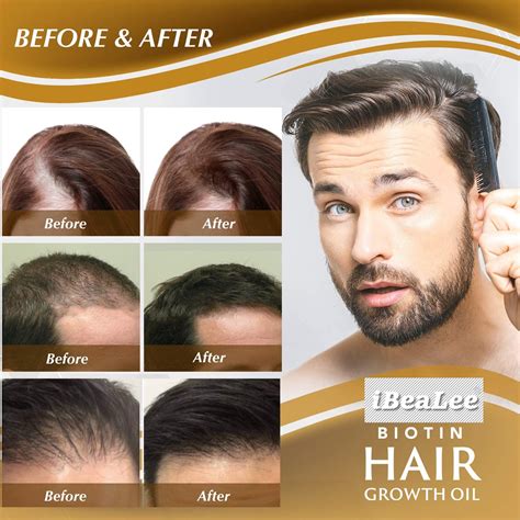 Ibealee Hair Growth Products Biotin Fast Growing Hair Care Essential Oils Anti Hair Loss Spray