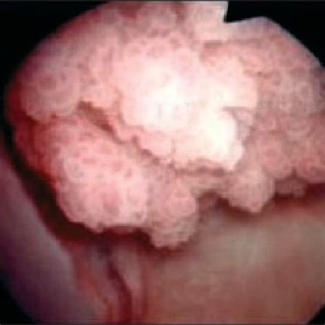 Cystoscopic Image Of Polypoid Urinary Bladder Tumor Image Courtesy Of
