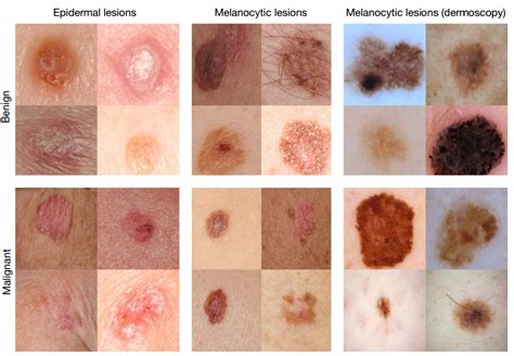 Deep Learning Algorithm Diagnoses Skin Cancer As Well As Seasoned Dermatologists Smith Weriatere