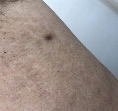 Found This Mark Under My Armpit Recently Is This Melanoma Im Really
