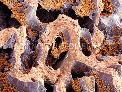 Md ☞ Bone Marrow Sem Scanning Electron Micrograph Sem Of Bone