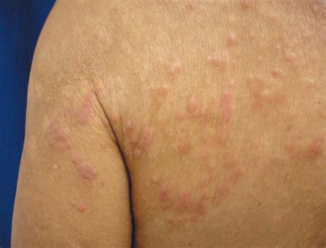 Erythematous Papules More Evident On Upper Trunk Download Scientific