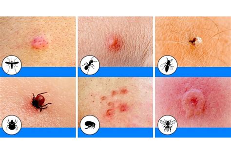 Chigger Bites Vs Bed Bug Bitesidentify Bug Bite Diffe