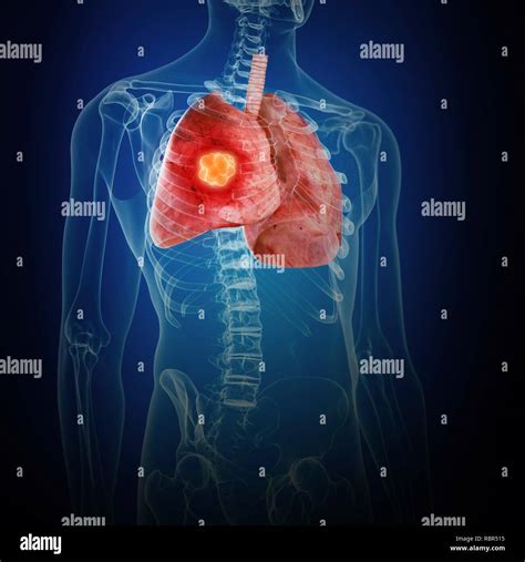 Illustration Of Lung Cancer Stock Photo Alamy
