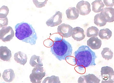 White Blood Cell Disorders College Of Medicine Com 1