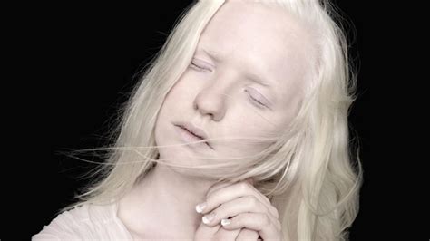 Czym Jest Albinizm Przyczyny Objawy Leczenie Hellozdrowie My XXX Hot Girl