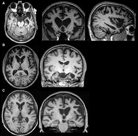Magnetic Resonance Imaging Mri In Three Variants Of Frontotemporal