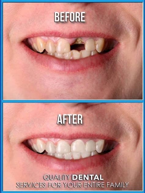 Dental Implants Pictures Before And After Photos Of Dental Implants