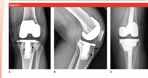 Figure 1 From Evaluating The Progression Of Osteolysis After Total Knee