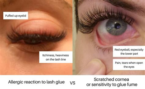 How To Recognize A Lash Allergy