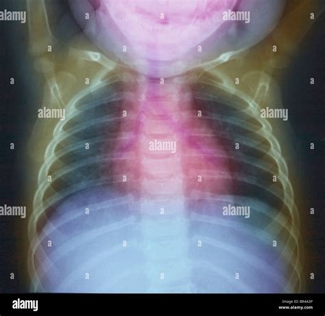 Infant X Ray Hi Res Stock Photography And Images Alamy