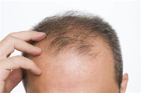 First In Man Study Appears To ‘awaken Dormant Hair Follicles Says Biotech