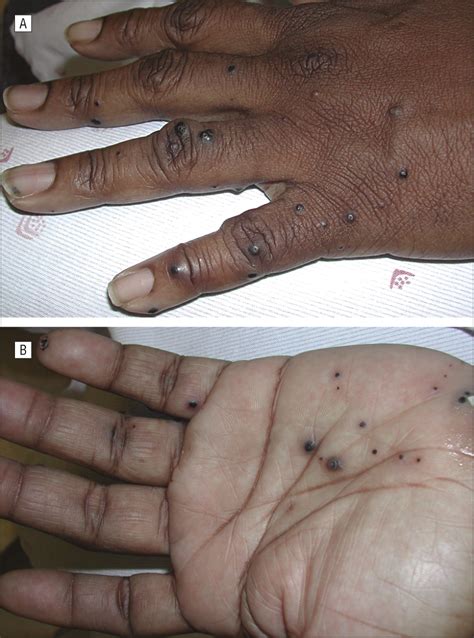 Successful Treatment Of Eruptive Unilateral Angiokeratomas Congenital