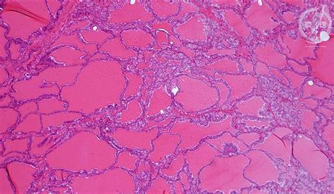 Check spelling or type a new query. 13.Endocrine (5) Graves disease|Pathology Core Pictures