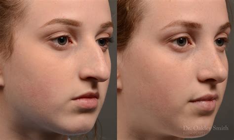 393b rhinoplasty dr oakley smith toronto nose job toronto rhinoplasty surgery nose