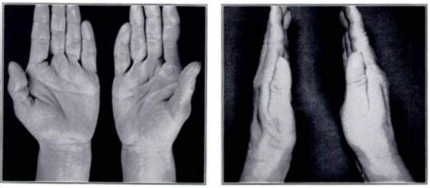 Fig2carpal Tunnel Syndrome Open I