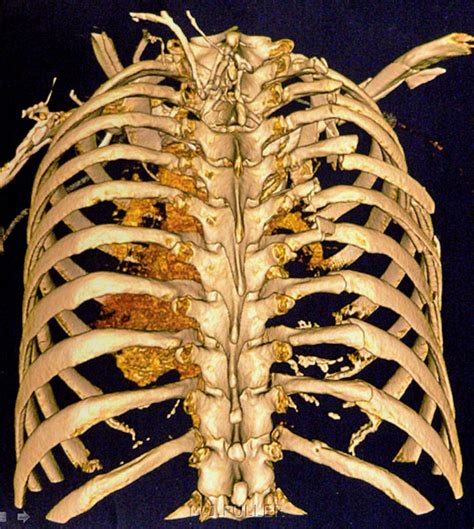 Imaging Rib Fractures Wikiradiography