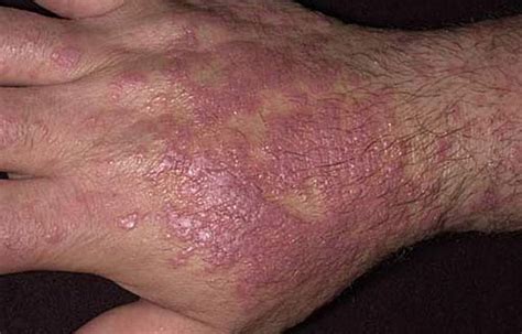 Lichen Planus Skin Disorders Merck Manuals Consumer Version